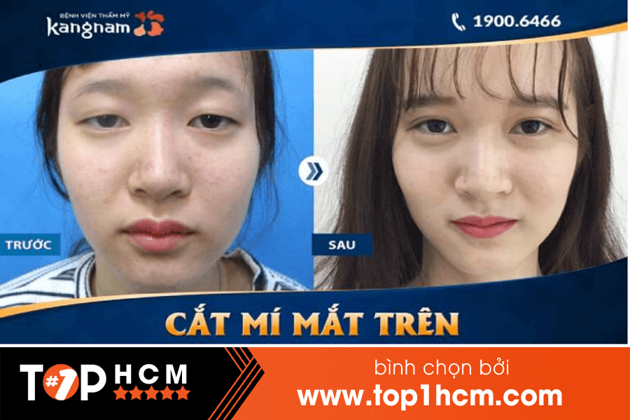 Cắt mí đẹp tại tphcm